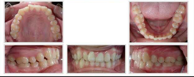 Invisalign teen case (no braces) before treatment
