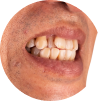 Upper Front Teeth Protrusion Example