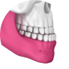 Underbite Example